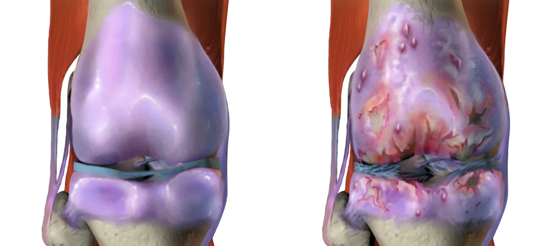 Understanding Sandhigata Vata (Osteoarthritis) and How Icchaherbals Ortho Pain Tablet Can Help