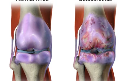 Understanding Sandhigata Vata (Osteoarthritis) and How Icchaherbals Ortho Pain Tablet Can Help