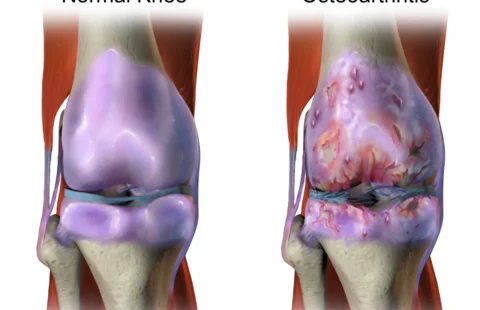 Understanding Sandhigata Vata (Osteoarthritis) and How Icchaherbals Ortho Pain Tablet Can Help