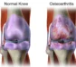 Understanding Sandhigata Vata (Osteoarthritis) and How Icchaherbals Ortho Pain Tablet Can Help