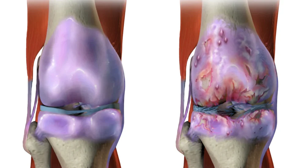 Understanding Sandhigata Vata (Osteoarthritis) and How Icchaherbals Ortho Pain Tablet Can Help